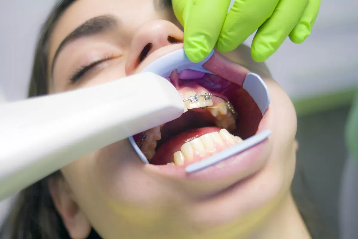 Tips Khusus Perawatan Gigi Behel yang Wajib Diketahui agar Tak Mengalami Kerusakan